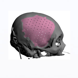 implante craniano sob medida