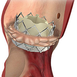 bioprótese valvar pulmonar / de tecido bovino / de cobalto-cromo / sem sutura