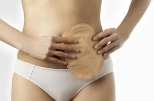 bolsa de ileostomia 1