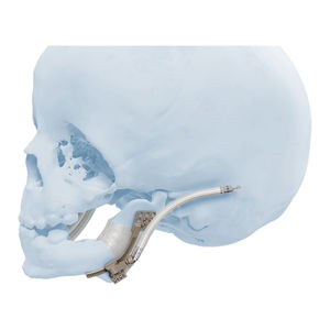 distrator mandibular