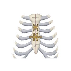 Placa de compressão óssea para mandíbula - MatrixORTHOGNATHIC