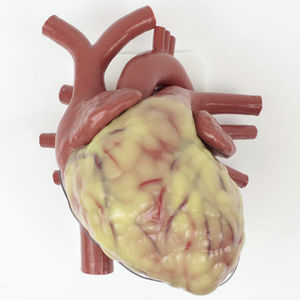 Modelo anatômico de aneurisma da aorta abdominal - 021 series