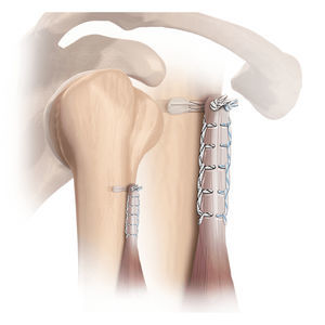 âncora de sutura tendão bicipital