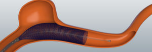 stent intracraniano / em nitinol / autoexpansível