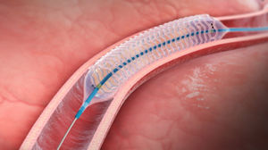 stent coronário