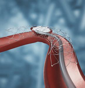 stent intracraniano / em nitinol / de suporte para espiral de embolização