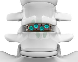 espaçador intervertebral lombar