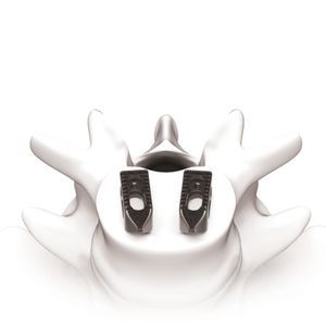 espaçador intervertebral toracolombar