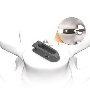 espaçador intervertebral toracolombar