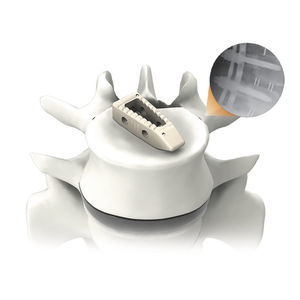 espaçador intervertebral toracolombar