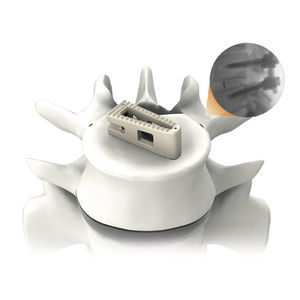 espaçador intervertebral toracolombar