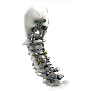 sistema de osteossíntese occípito-cérvico-torácico