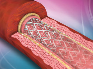 stent coronário