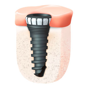 implante dentário cônico