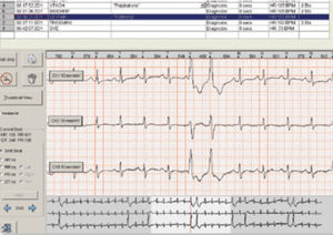 software para holter cardíaco