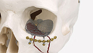 implante periorbital