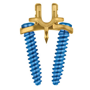 grampo para artrodese vertebral anterior