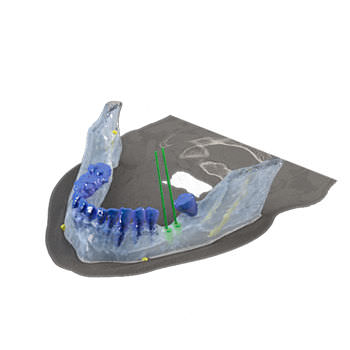 Software para implantodontia - Reconstruction 3D - Drive Dental Implants - de simulação de implante dentário / de visualização 3D / de modelagem