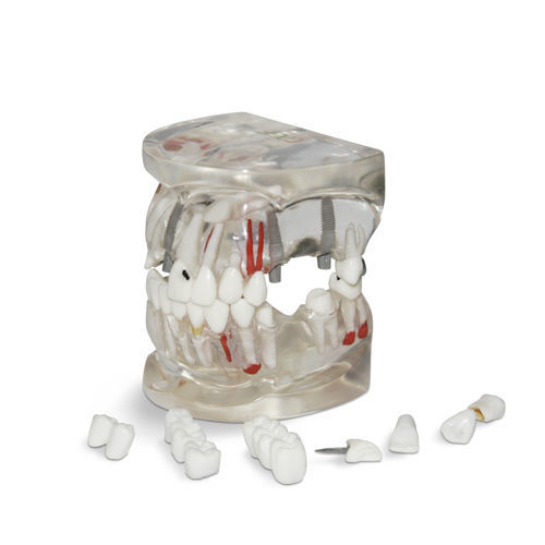 Modelo de nervo - T04 - GF DENTAL - mandibular / de dentes / para implantodontia