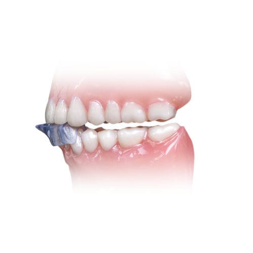 Aparelho intraoral para bruxismo - NTI-tss Plus® - Glidewell Europe