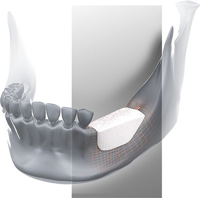 Aloenxerto ósseo - Global D - para cirurgia odontológica / rígido