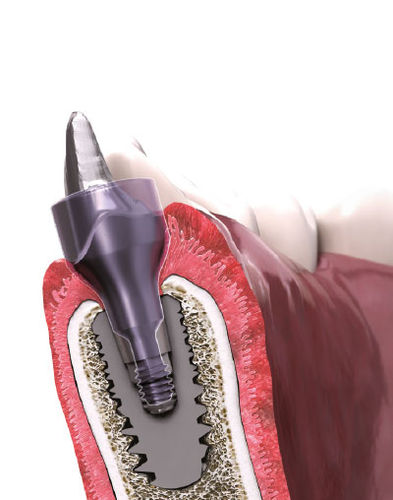 Pilar de cicatrização - IN-KONE® - Global D