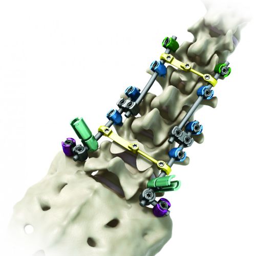 Sistema de osteossíntese toracolombossacral - Streamline® TL - RTI Surgical - via posterior