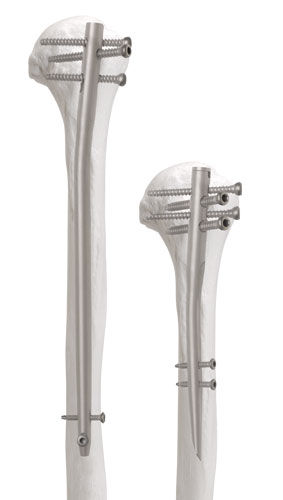 Haste intramedular para úmero - Newton™ - AOS - Advanced Orthopaedic Solutions - fixação proximal