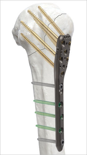 Placa de compressão óssea para úmero - AOS - Advanced Orthopaedic Solutions - proximal / bloqueada / metálica