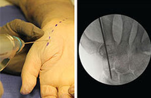 Parafuso para artrodese para articulação metacarpofalangeana - REDUCT™ - Skeletal Dynamics - para falange da mão / sem cabeça / metálico