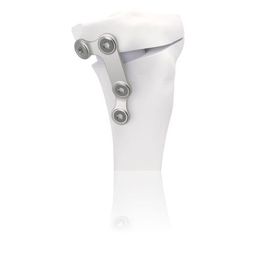 Placa de osteotomia para tíbia - TBFIX™ - Groupe Lépine - em aço inoxidável