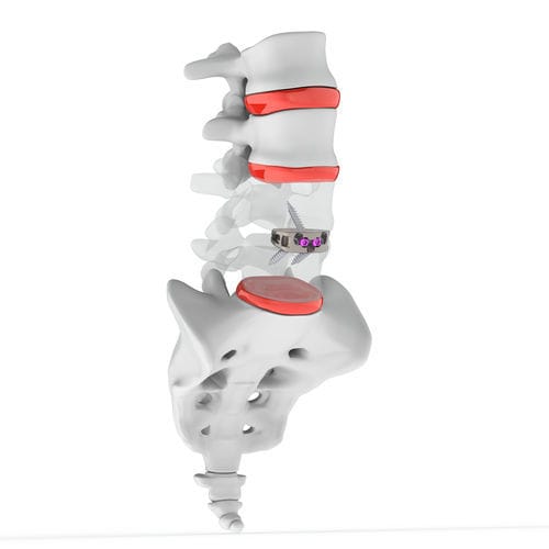 Espaçador intervertebral lombar - ANTENOR STAND ALONE ALIF CAGE - Osimplant - via anterior / em titânio