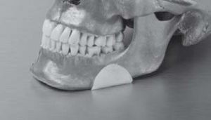 Implante mandibular - OP7550 - Matrix Surgical USA - anatômico / em polietileno