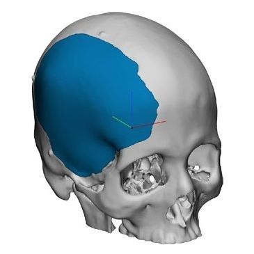 Prótese craniana sob medida - OP89020 - Matrix Surgical USA