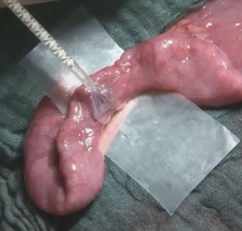 Cola cirúrgica para cirurgia vascular - VIVO - Adhesys Medical
