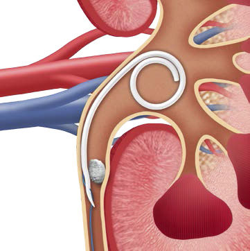 Stent ureteral - JFil®  - ROCAMED - em nitinol