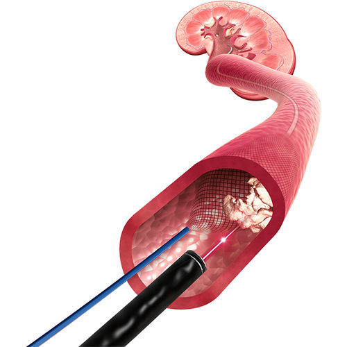 Stent de artéria renal - X-Filter™ - ROCAMED - em nitinol