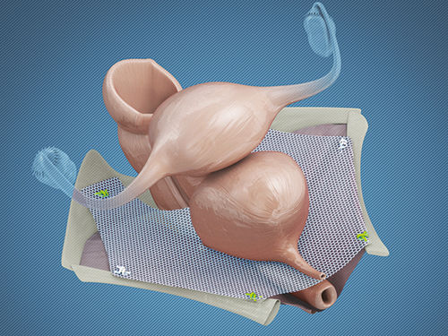 Implante de reconstrução do assoalho pélvico - InGYNious - AMI - Agency for Medical Innovations - via transvaginal / para mulher