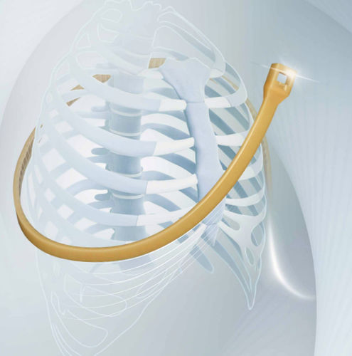 Fio de cerclagem óssea para fechamento do esterno - SternoEaZip® - Kontour Medical Technology - monofilamentar polimérico