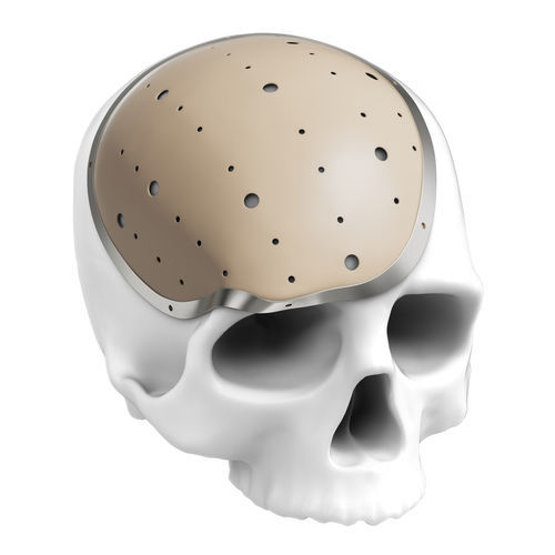 Prótese craniana sob medida - Kontour Medical Technology