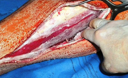 Simulador para treinamento - Operative Experience Inc. - de fasciotomia / cirúrgico / de perna
