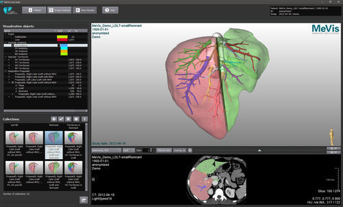 Software de análise de imagens - MeVis  - VAREX Imaging - de visualização / de planejamento de tratamento / de importação