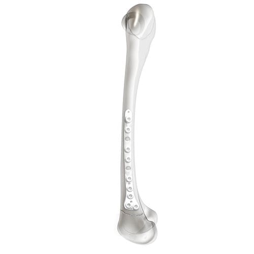 Placa de compressão óssea para fêmur - PediLoc® - OrthoPediatrics - distal / lateral / bloqueada