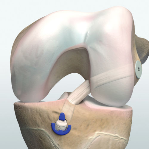 Kit de instrumentos para reconstrução do ligamento cruzado anterior - ACL - OrthoPediatrics