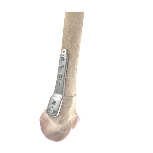 Placa de osteotomia para fêmur - 00-1050-5104 - OrthoPediatrics - distal / bloqueada / metálica