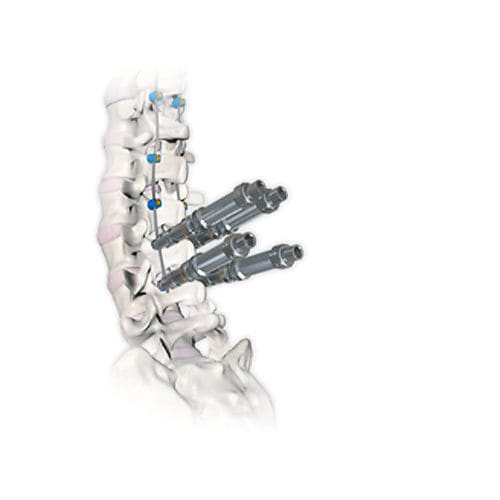 Sistema de osteossíntese toracolombar - RESPONSE™ 4.5/5.0 - OrthoPediatrics - via posterior / infantil