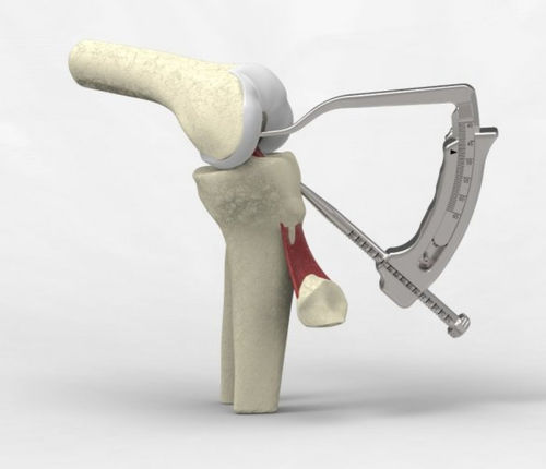 Kit de instrumentos para reconstrução do ligamento cruzado anterior - NeoSys Medical Solutions