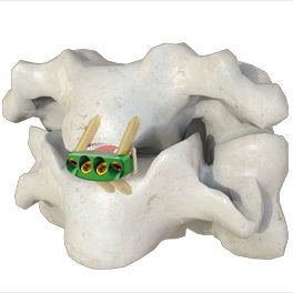 Espaçador intervertebral cervical - 0-P - Irene Ortho - via anterior / com placa óssea cervical