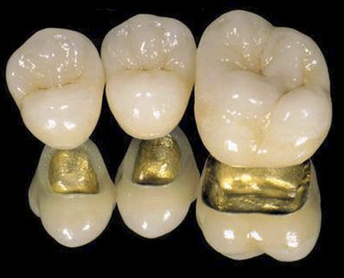 Coroa dentária metalocerâmica - CLASSIC  - Derby Dental - para dentes anteriores / para dentes posteriores
