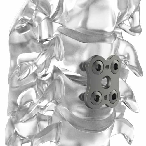 Placa para artrodese cervical - PM BUTTERFLY® - NEURO FRANCE Implants - bloqueada / em titânio / 2 níveis
